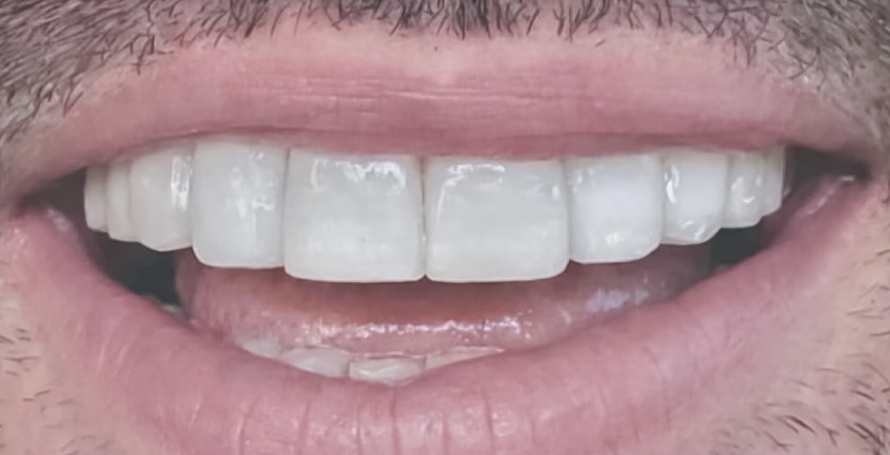 Direct veneers result after treatment